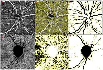 Efficacy and safety of platelet-rich plasma for acute nonarteritic anterior ischemic optic neuropathy: a prospective cohort study